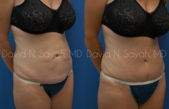 Tummy Tuck Before and After | Sayah Institute