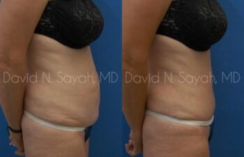 Tummy Tuck Before and After | Sayah Institute