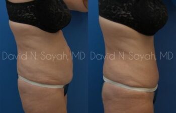 Tummy Tuck Before and After | Sayah Institute