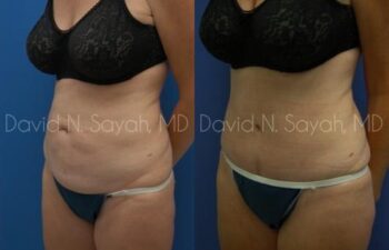 Tummy Tuck Before and After | Sayah Institute