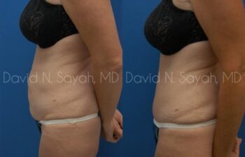 Tummy Tuck Before and After | Sayah Institute