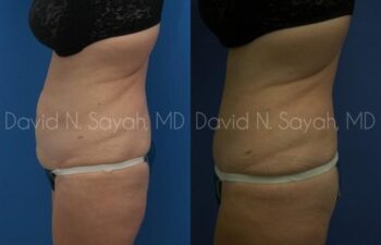 Tummy Tuck Before and After | Sayah Institute