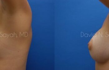 Breast Augmentation Before and After | Sayah Institute