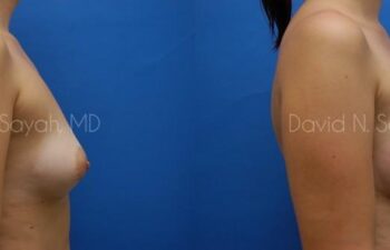 Breast Augmentation Before and After | Sayah Institute