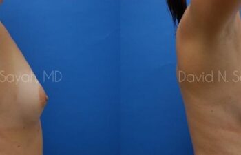 Breast Augmentation Before and After | Sayah Institute