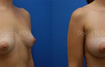 Breast Augmentation Before and After | Sayah Institute
