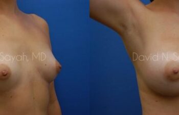 Breast Augmentation Before and After | Sayah Institute