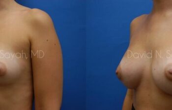 Breast Augmentation Before and After | Sayah Institute
