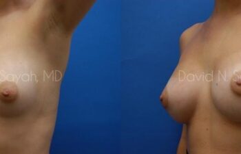 Breast Augmentation Before and After | Sayah Institute