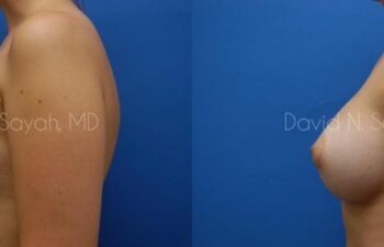 Breast Augmentation Before and After | Sayah Institute