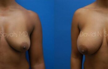 Breast Augmentation Before and After | Sayah Institute