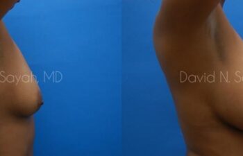 Breast Augmentation Before and After | Sayah Institute