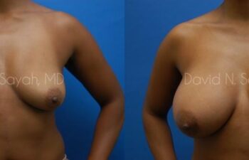Breast Augmentation Before and After | Sayah Institute
