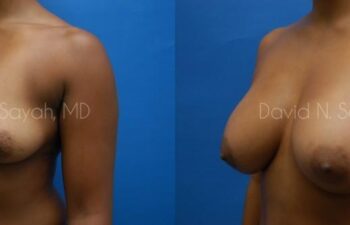 Breast Augmentation Before and After | Sayah Institute