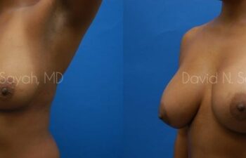 Breast Augmentation Before and After | Sayah Institute