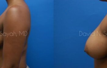 Breast Augmentation Before and After | Sayah Institute