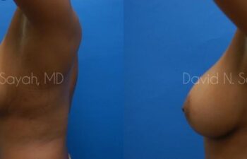 Breast Augmentation Before and After | Sayah Institute