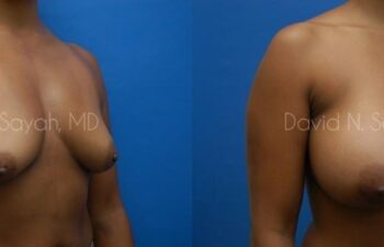 Breast Augmentation Before and After | Sayah Institute