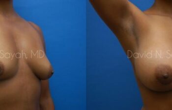 Breast Augmentation Before and After | Sayah Institute