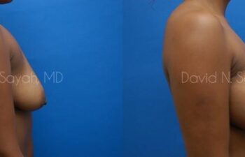 Breast Augmentation Before and After | Sayah Institute