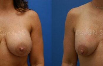 Breast Implant Revision Before and After | Sayah Institute