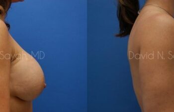 Breast Implant Revision Before and After | Sayah Institute