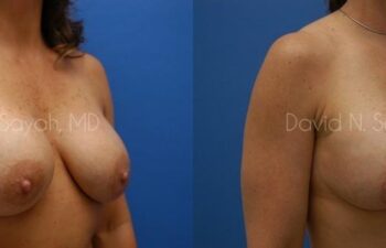 Breast Implant Revision Before and After | Sayah Institute