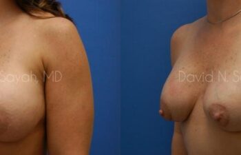 Breast Implant Revision Before and After | Sayah Institute