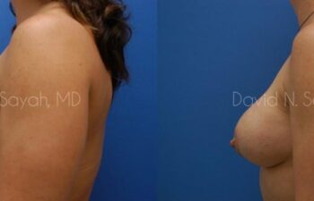 Breast Implant Revision Before and After | Sayah Institute