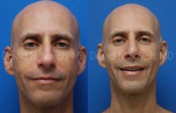 Fat Injection Face Before and After | Sayah Institute