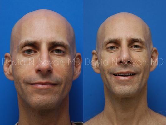 Fat Injection Face Before and After | Sayah Institute