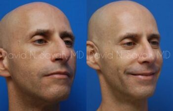 Fat Injection Face Before and After | Sayah Institute
