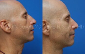 Fat Injection Face Before and After | Sayah Institute