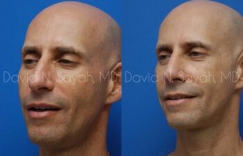 Fat Injection Face Before and After | Sayah Institute