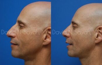 Fat Injection Face Before and After | Sayah Institute