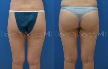 Gluteal Augmentation Before and After | Sayah Institute