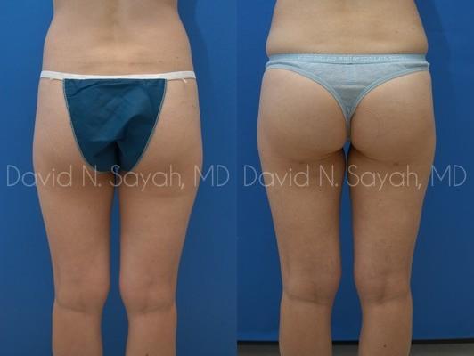 Gluteal Augmentation Before and After | Sayah Institute