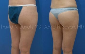 Gluteal Augmentation Before and After | Sayah Institute