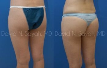 Gluteal Augmentation Before and After | Sayah Institute