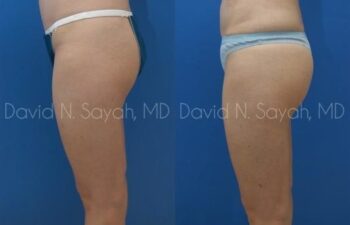 Gluteal Augmentation Before and After | Sayah Institute
