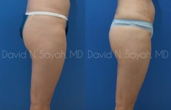 Gluteal Augmentation Before and After | Sayah Institute