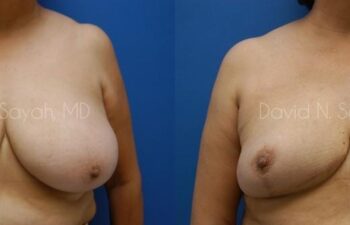 Breast Reduction Before and After | Sayah Institute