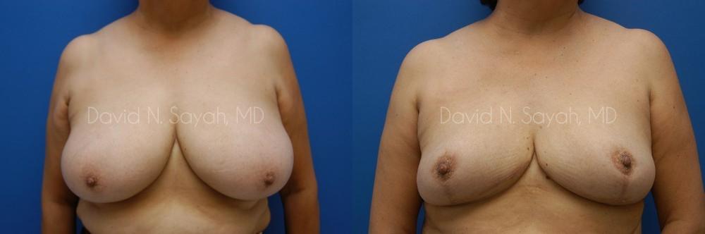 Breast Reduction Before and After | Sayah Institute