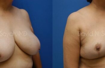 Breast Reduction Before and After | Sayah Institute