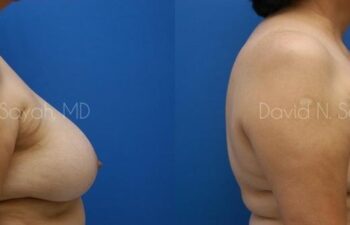 Breast Reduction Before and After | Sayah Institute