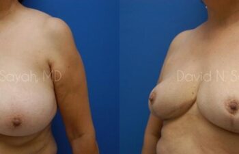 Breast Reduction Before and After | Sayah Institute