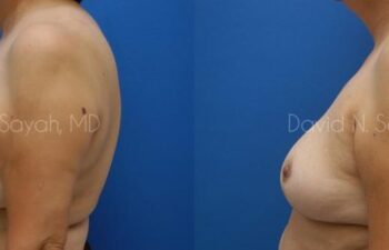 Breast Reduction Before and After | Sayah Institute