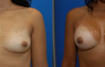 Breast Augmentation Before and After | Sayah Institute