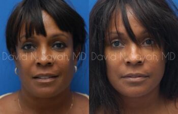 Facelift Before and After | Sayah Institute
