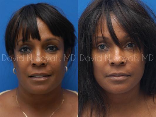 Facelift Before and After | Sayah Institute